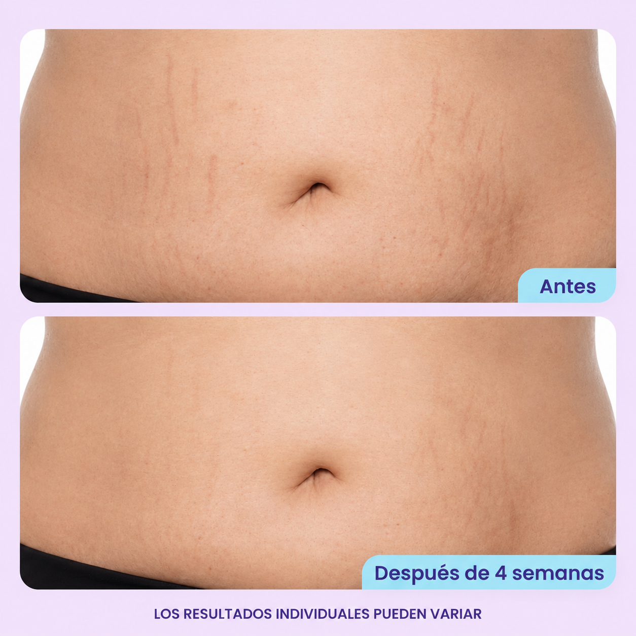 Alune™ Crema Suavizante para el Vientre