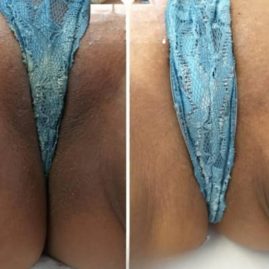 Antes y después usando Azúcar Glow Exfoliator en zonas íntimas